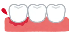 歯ぐきから血が出る 歯医者